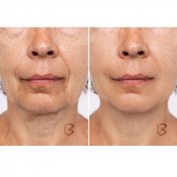 Beautifly B-Glossy Blush dispozitiv de mezoterapie non-invazivă, Stimularea metabolismului celular, Fototerapie și terapie ionică, Reduce ridurile și semnele de acnee, Roz