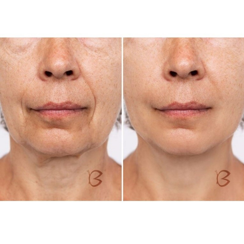 Beautifly B-Glossy Blush dispozitiv de mezoterapie non-invazivă, Stimularea metabolismului celular, Fototerapie și terapie ionică, Reduce ridurile și semnele de acnee, Roz