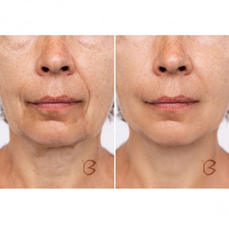 Beautifly B-Glossy Blush dispozitiv de mezoterapie non-invazivă, Stimularea metabolismului celular, Fototerapie și terapie ionică, Reduce ridurile și semnele de acnee, Roz