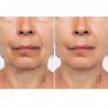 Beautifly B-Glossy Blush dispozitiv de mezoterapie non-invazivă, Stimularea metabolismului celular, Fototerapie și terapie ionică, Reduce ridurile și semnele de acnee, Roz