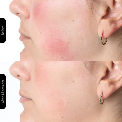 Mască fototerapeutică pentru față Silk'n LED Face Mask 100 FLM100PE1001, autonomie de 130 de minute, 4 moduri, sesiune de 10 minute, design flexibil, alb